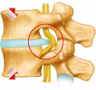 怎么预防腰椎间盘突出复发,腰椎间盘突出症预防方法宣教