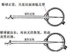 如何区分真假近视三招全搞定,近视怎么判定要不要换眼镜