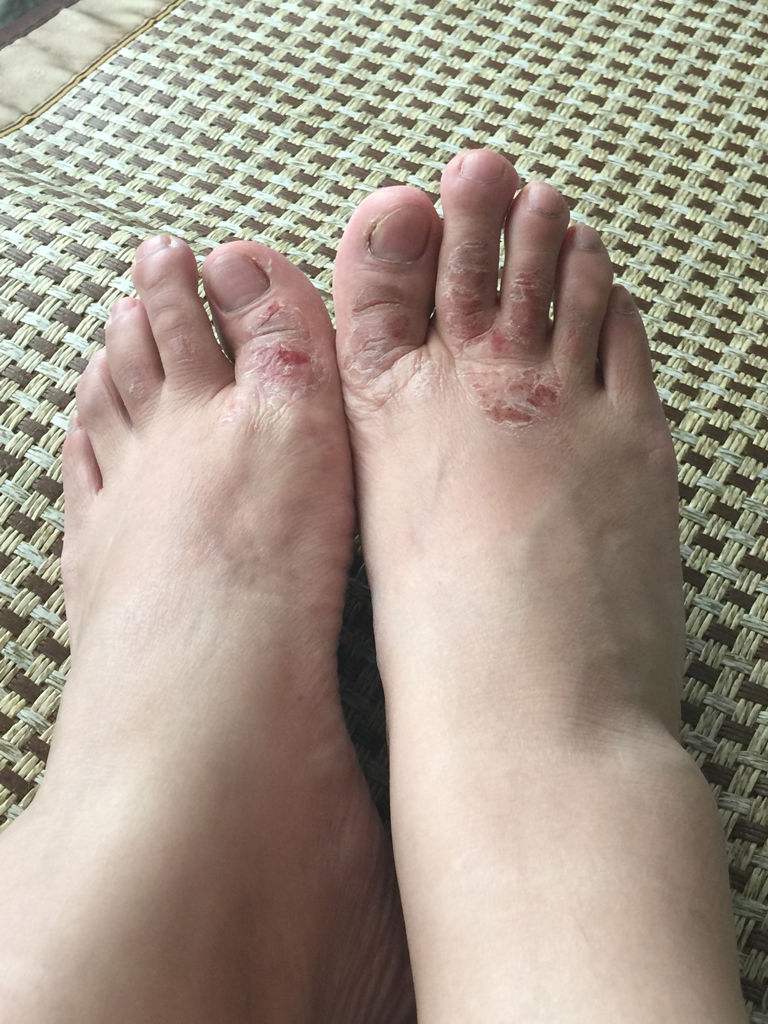 脚气发白发臭的自制小偏方,脚气痒脚底皮增厚有什么小偏方