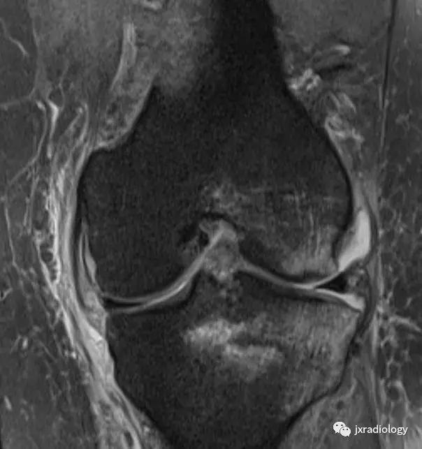 膝关节骨髓水肿疼痛特点,膝关节骨髓水肿的临床表现