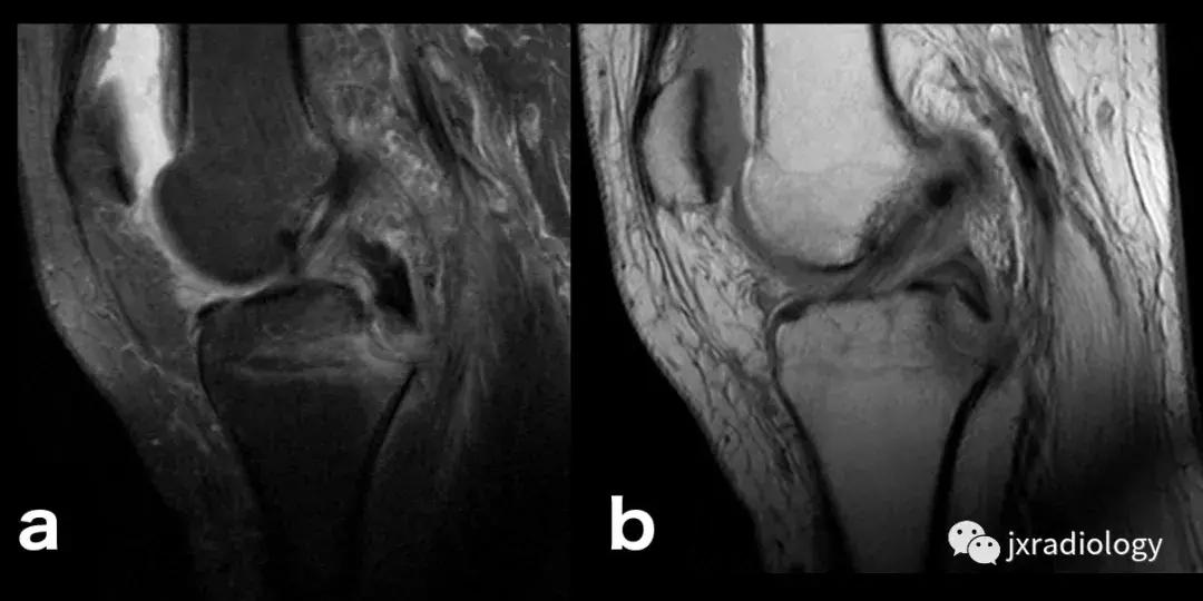 膝关节骨髓水肿疼痛特点,膝关节骨髓水肿的临床表现