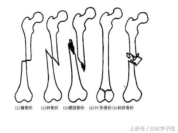 古代人骨折处理方法,古代骨折是怎么处理的