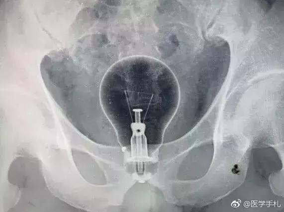 灯泡塞进肛门，医生微博求助手术方案……
