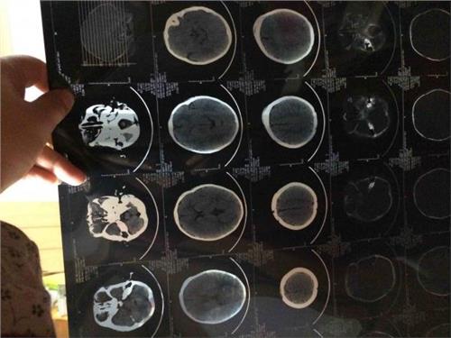 宝宝额头摔大包怎么判断孩子没事,宝宝额头摔个大包怎么处理