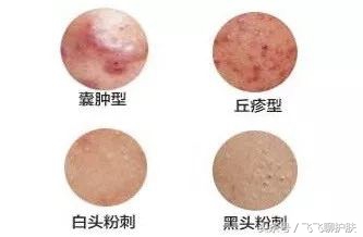 大概只有自己最清楚为什么长痘,各种痘痘类型都是如何产生的