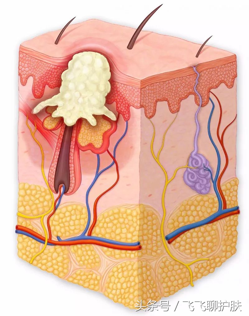 各种痘痘的类型及治疗方法,四种常见的痘痘类型应该如何区分
