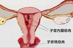 你也月经过多？或怀不上？妇科医生建议——排查子宫内膜息肉！