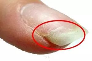 怎么从指甲上看健康图解,从指甲看疾病的图片说明