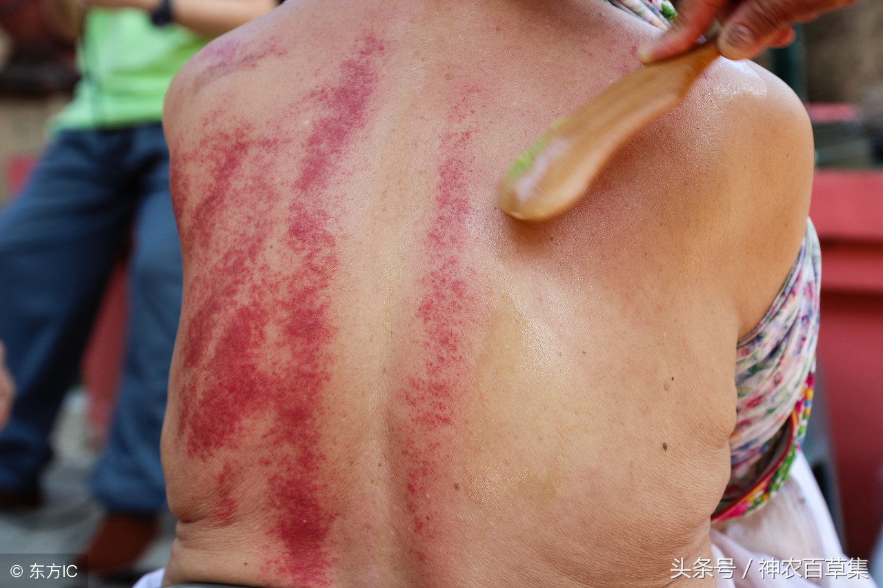 刮痧疗法是谁发明的,中医刮痧疗法是什么