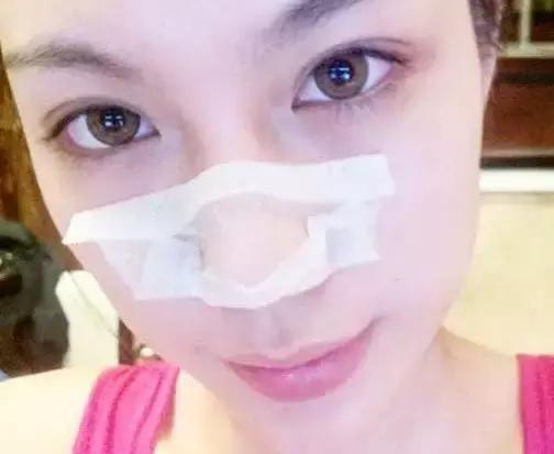 鼻子黑头多毛孔粗大出油怎么办,鼻子黑头出油怎么办小窍门