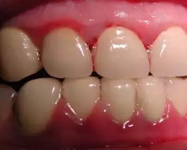 有一个牙齿的牙龈一碰就出血,牙龈萎缩还一碰就出血怎么回事