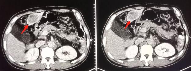 肝癌晚期肝硬化腹水能活多少时间,肝癌晚期用钇90疗法能活多少年