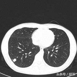 肺结核钙化会转成肺癌吗,肺结核病灶已经钙化是怎么回事