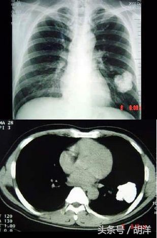 肺结核钙化会转成肺癌吗,肺结核病灶已经钙化是怎么回事