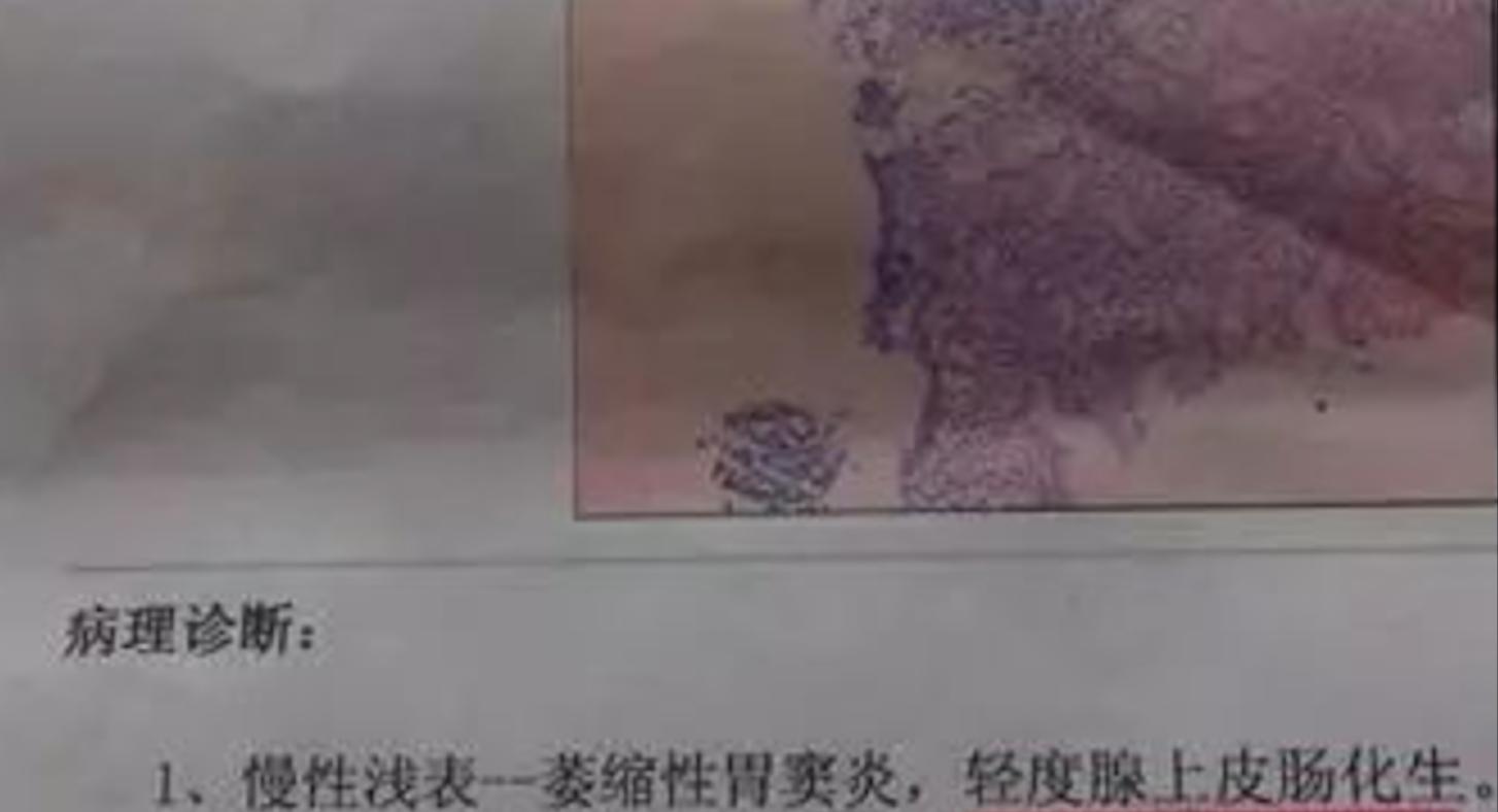 什么是慢性胃炎伴肠上皮化生？