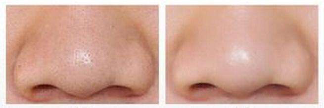 黑头太多怎么办用什么药膏来改善,黑头太多怎么办男生