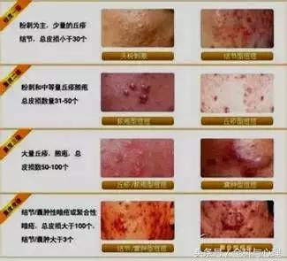 疮分为哪几种,疮疡的按诊方法