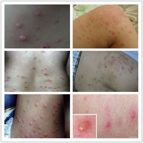 宝宝被蚊虫咬了几天了红肿硬块疼,婴幼儿蚊虫叮咬性皮炎破溃怎么办