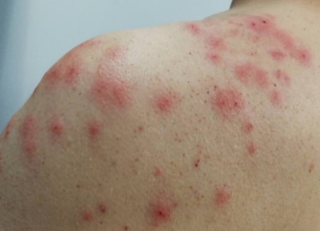 被蚊子咬了起了荨麻疹,被蚊子咬了起荨麻疹