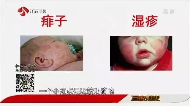 湿疹or痱子教你正确区分与治疗,如何正确判断湿疹与痱子