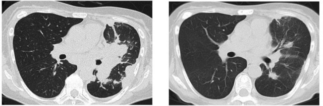 印度卡布宁caprane克唑替尼，阿法替尼和奥希替尼真实患者案例