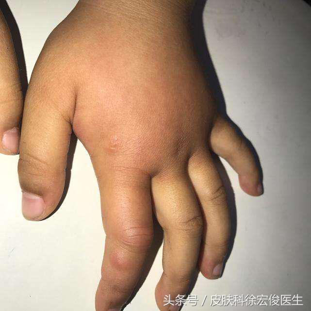 宝宝被蚊子叮了每次都抓破出血,宝宝被蚊子叮了用针管吸可以吗