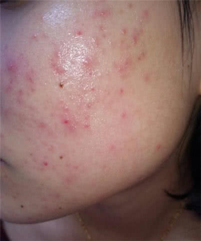 螨虫在脸上会吃成坑吗,螨虫吃进肚子里会怎样