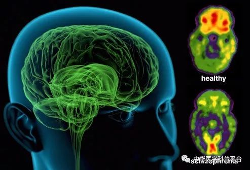 精神分裂症的表现,精神分裂症