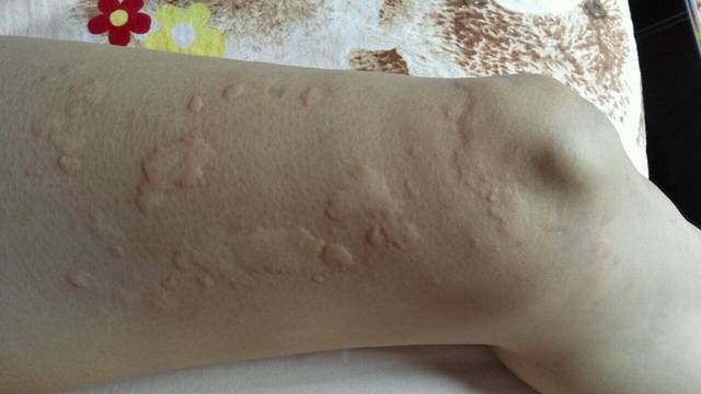 通宣理肺丸搭配什么中成药治麻疹,麻疹中医基本治疗原则是什么