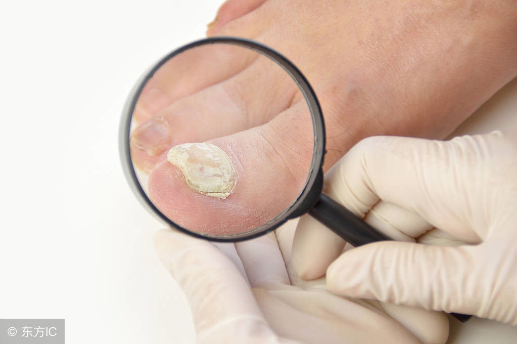 手足癣的传播途径是啥？有啥危害表现