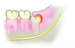 牙龈为什么老是上火肿痛吃什么药,冬天经常牙龈上火肿痛是什么原因