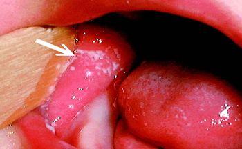 宝宝嘴里有很多奶垢,宝宝嘴里有像痰一样的奶