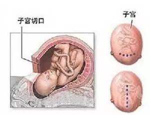 瘢痕子宫合并宫内早孕,瘢痕子宫单角子宫怀孕危险