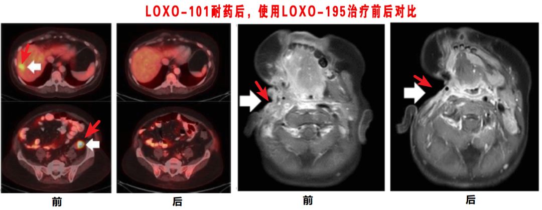 神奇制药抗癌药取得突破,神奇制药抗癌专利