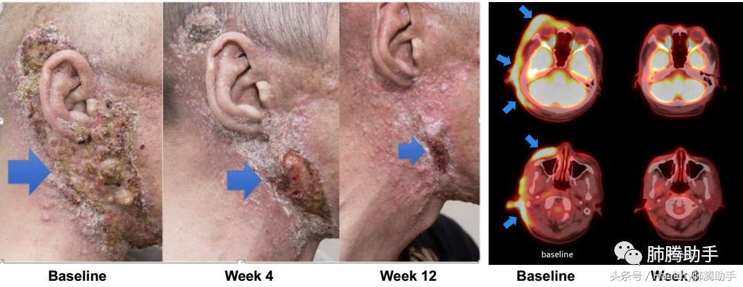 美国新上市的抗肺癌药物,asco抗癌新药