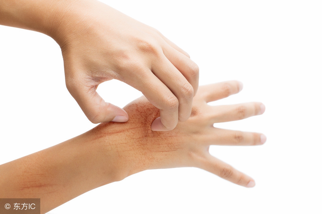 手上出汗汗疱疹怎么治才能除根,汗疱疹的症状及治疗方法