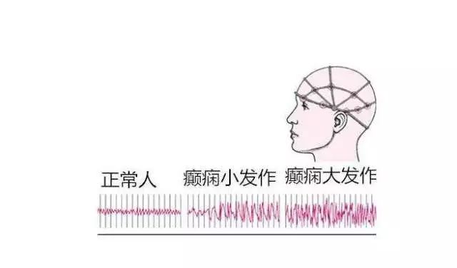 正经的羊癫疯,尴尬的羊癫疯