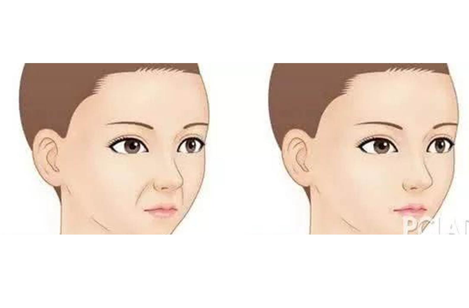 如何解决掉显老又讨厌的法令纹,法令纹不用愁一招帮你改善