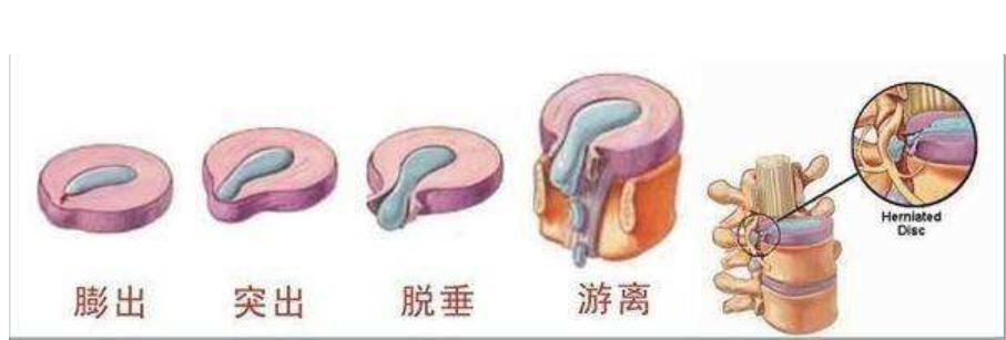 腰椎间盘突出腰腿疼痛怎么缓解,腰椎间盘突出腰腿疼痛特效验方