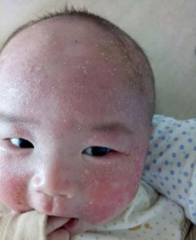 宝妈容易长痱子,宝妈长痱子