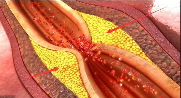 脑血栓和脑梗怎么彻底治疗,脑血栓和脑梗能治好吗