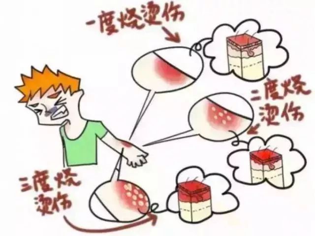 女孩被100度开水烫伤怎么办,女孩掉进汤锅烫伤