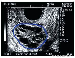 女性多囊专题,正视多囊别害怕
