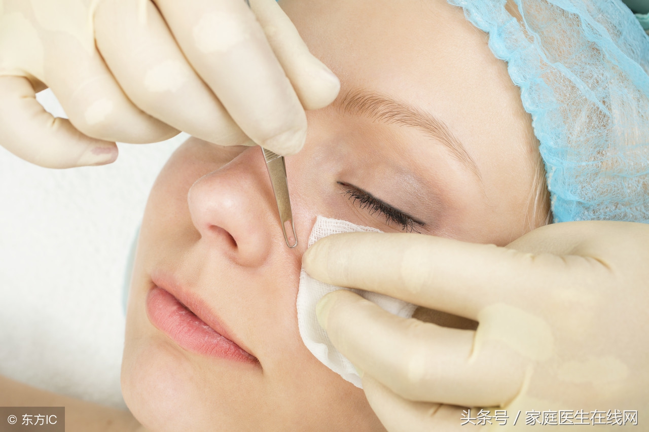 鼻头挤出的油脂怎么去除,鼻头有白色的东西冒出来怎么回事