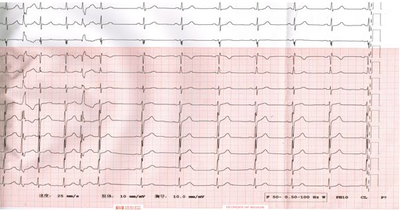 房颤伴窦性停搏怎么治,李广平心脏起搏视频