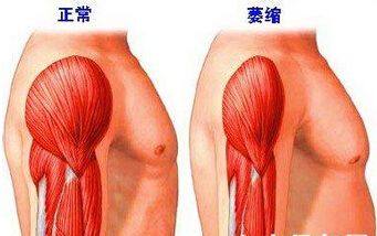 肩周炎冻结肩能治愈吗,肩周炎冻结肩锻炼视频