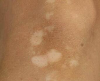 日常生活中白癜风患者应注意什么,邯郸治疗白癜风最佳时间