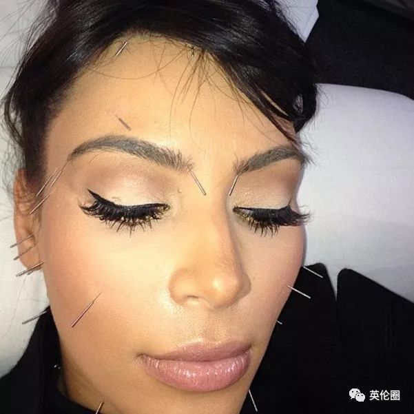 哈里梅根婚前求助中医！歪果仁已经把针灸吹上了天