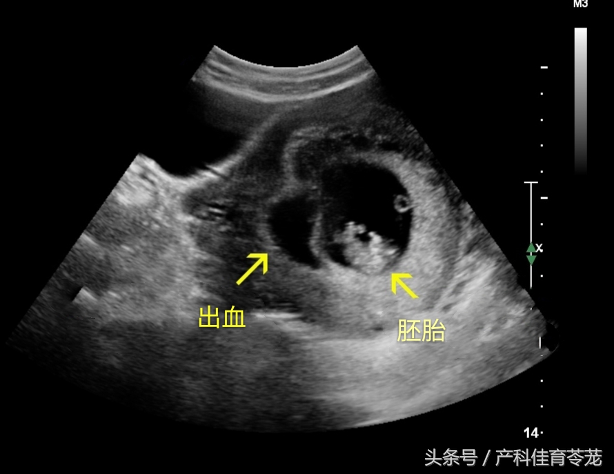 怀孕b超说有血流信号,怀孕了b超显示有积液好吗