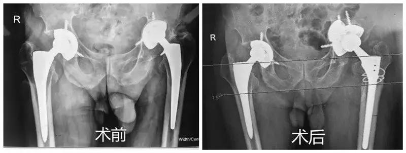 老年人关节老化需要做手术吗,老年人关节老化要动手术吗